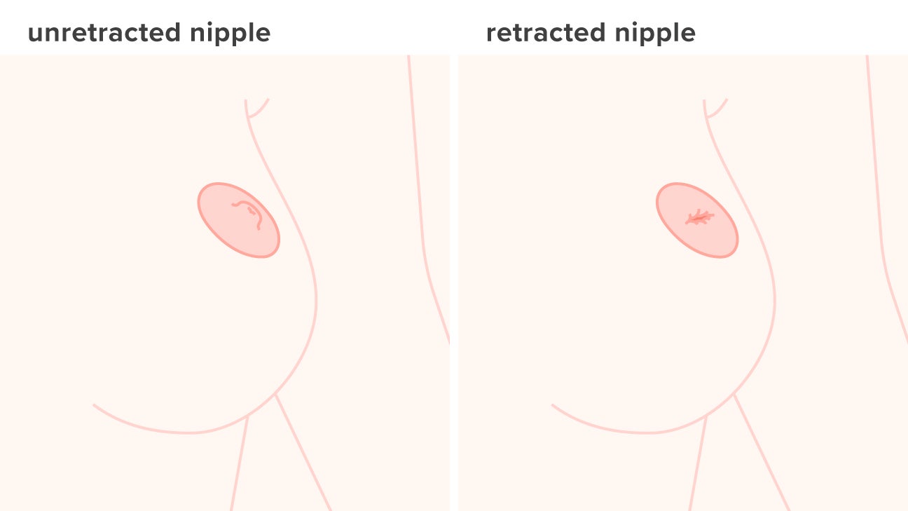 Pulling nipple
