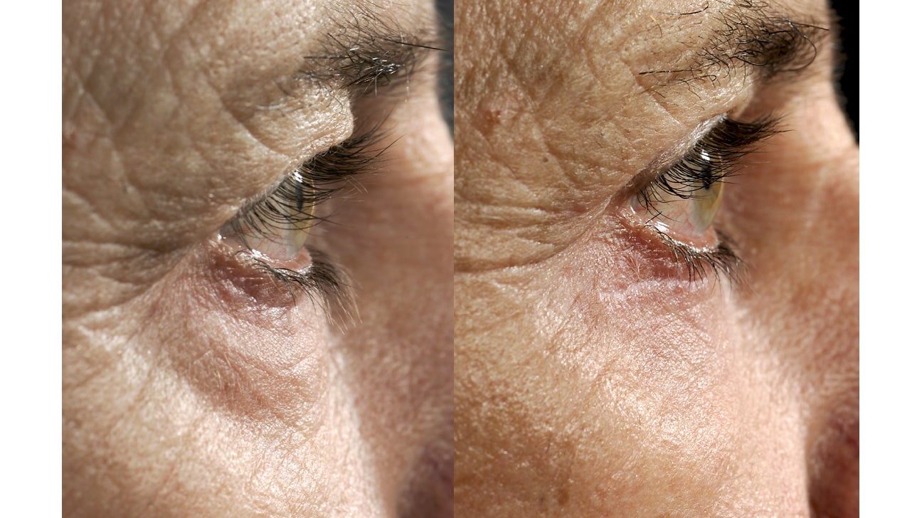How Much Does Eyelid Surgery Cost  Williams Center Williams Center