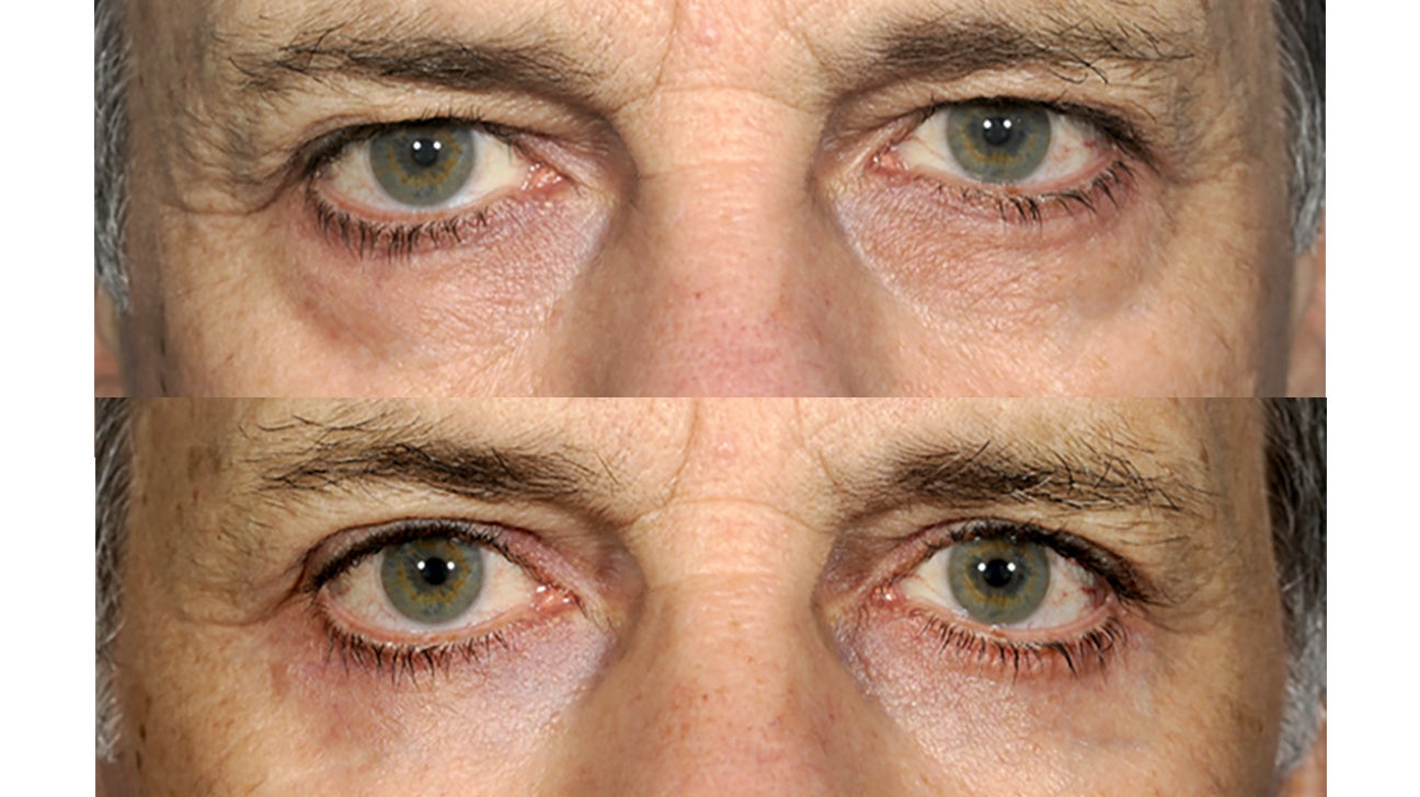 eyelid surgery before after