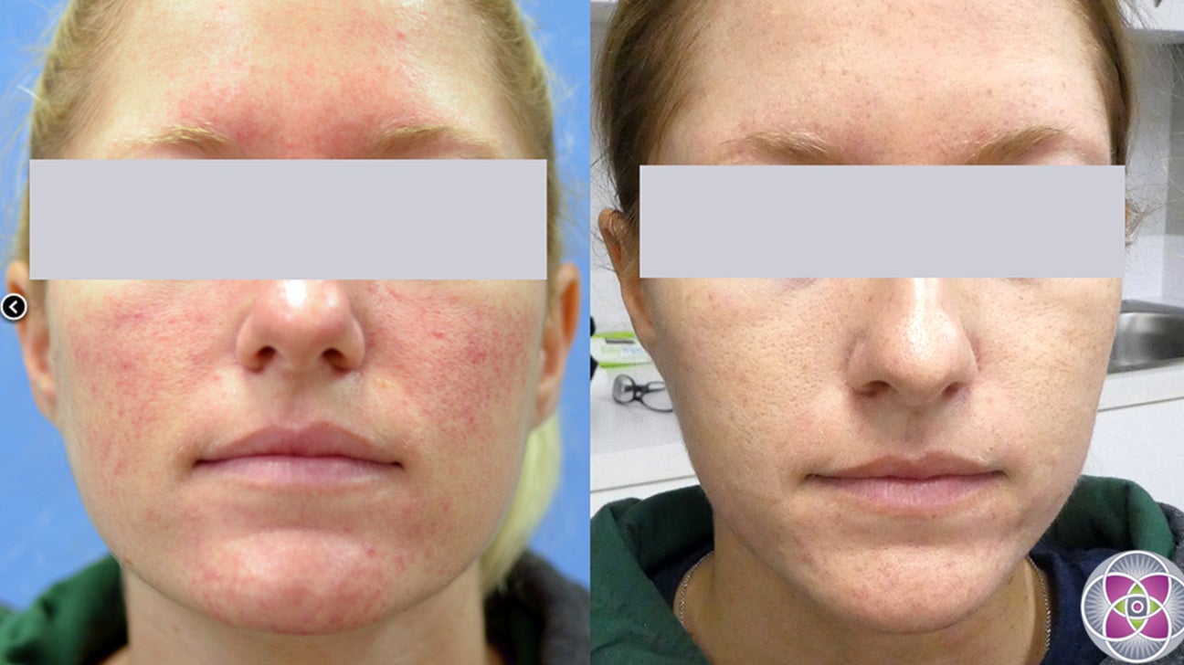 Nieuwsgierigheid tv station nauwelijks Laser Treatment for Rosacea: Types, Efficacy, Side Effects, and More