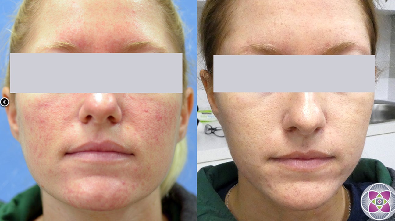 green light therapy for rosacea