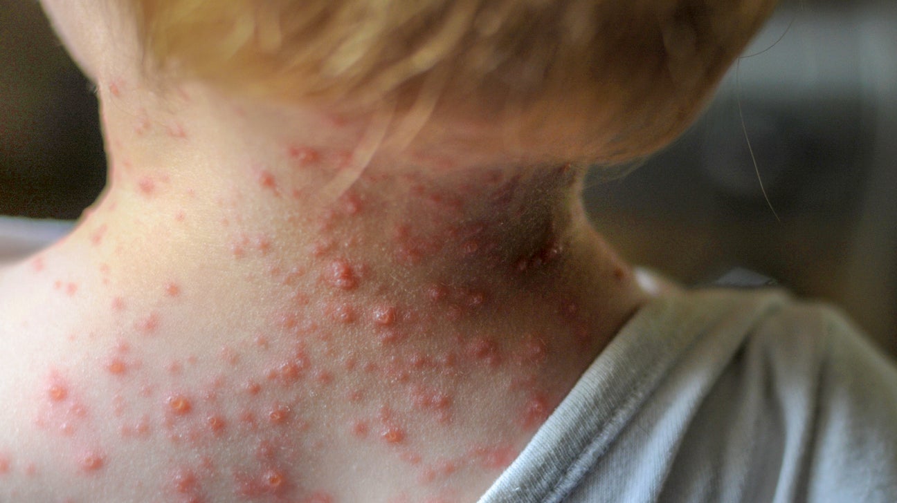 Roseola Rash