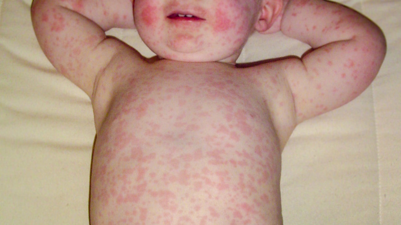 Rash on baby body no fever