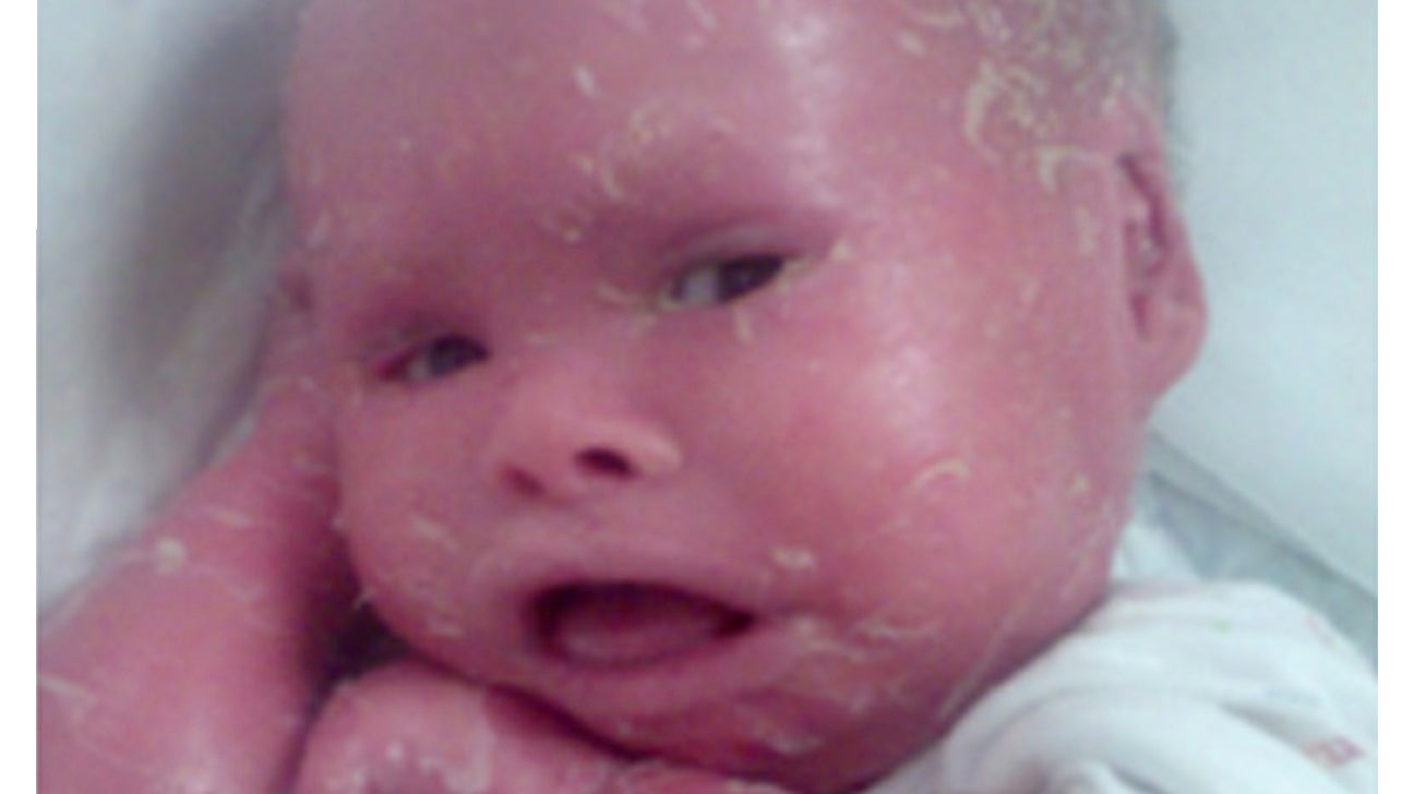 Newborn Baby With Harlequin Ichthyosis - newborn baby