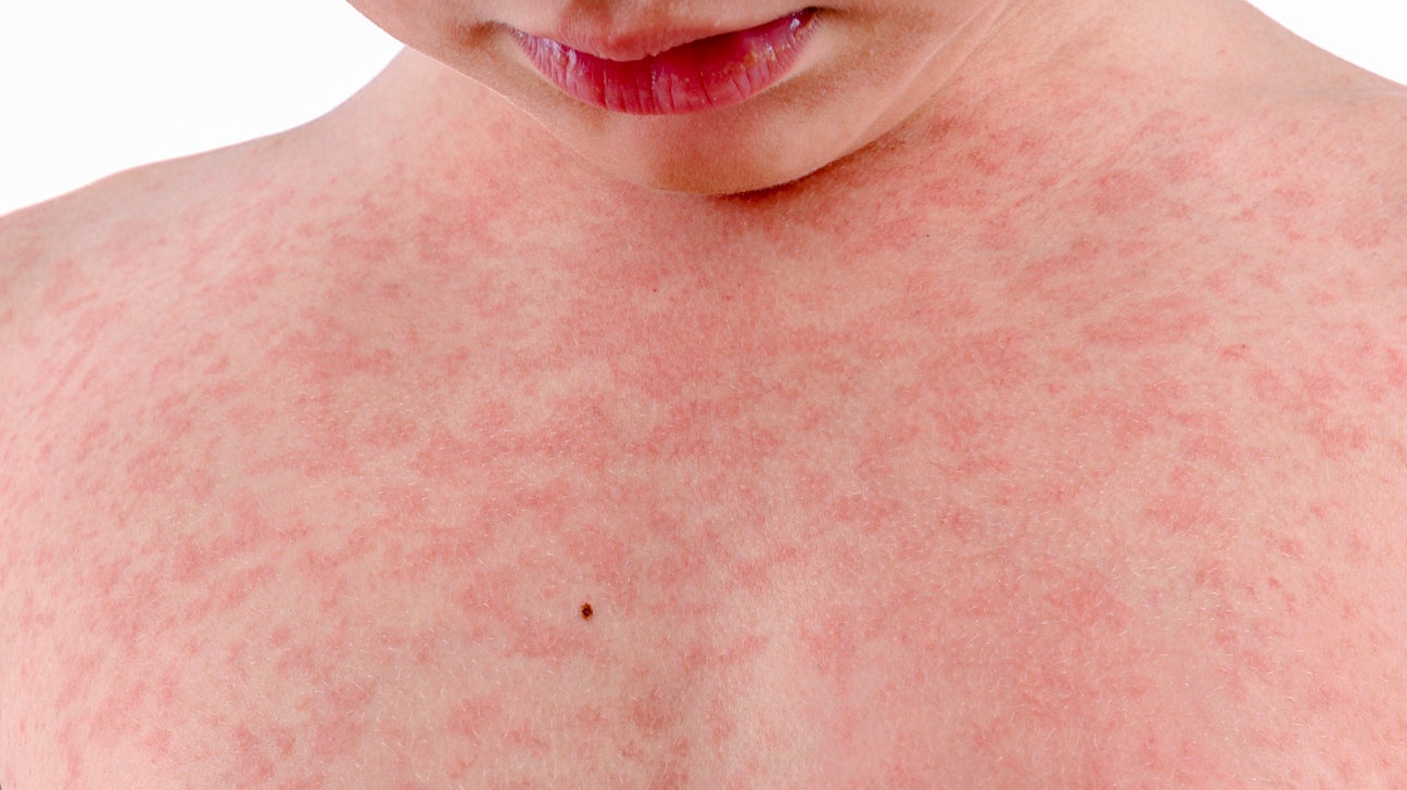 Skin Rashes That Itch All Over Body Kidgros