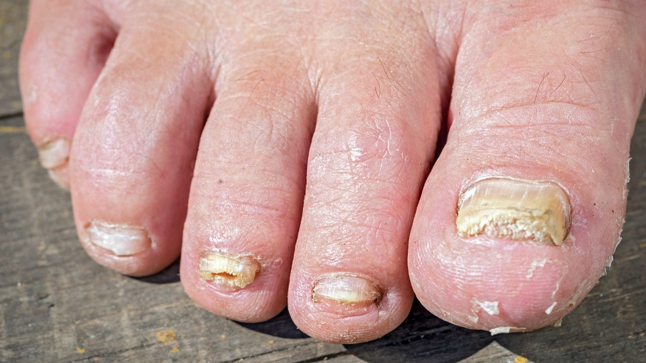 Toenail store discoloration white