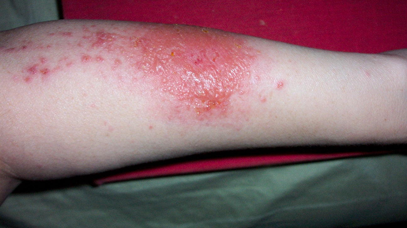 Pictures Of Poison Ivy Poison Oak And Poison Sumac Rashes - the meta ...