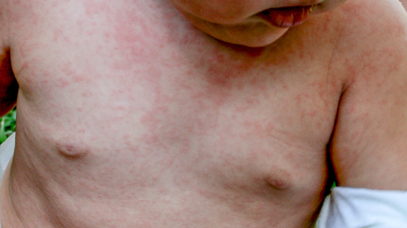 Viral Rashes in Babies: Types, Pictures, Diagnosis, Treatment
