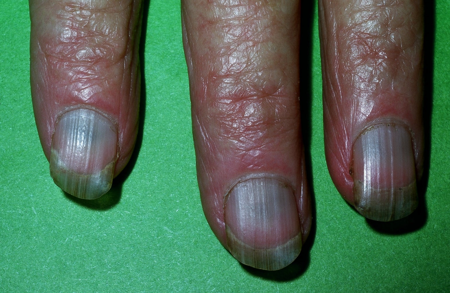 A, Right hand. Slate-black diffuse hyperpigmentation of small... | Download  Scientific Diagram