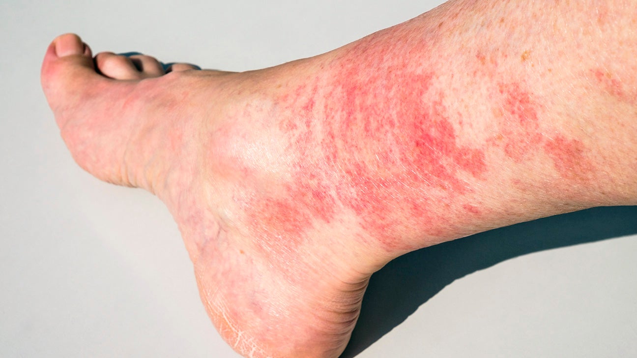 Diabetic Rash On Lower Leg