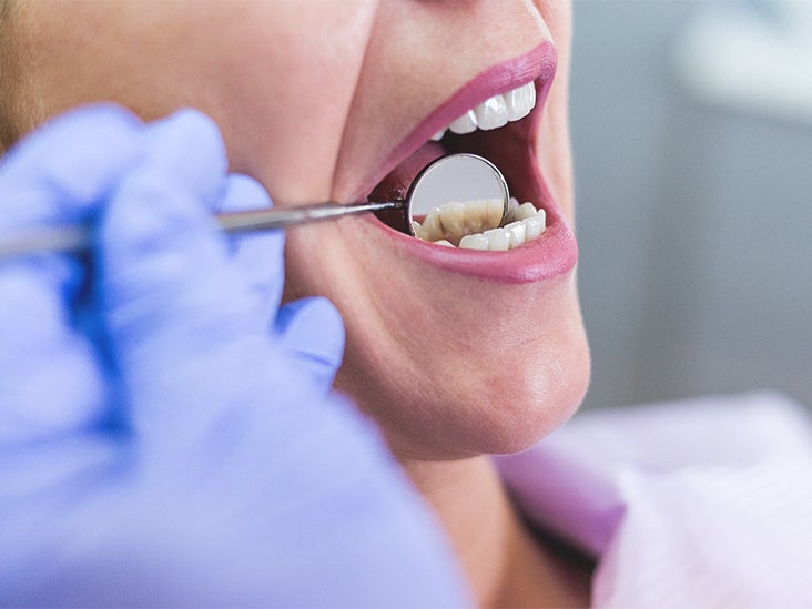 Do hurt why fillings Tooth sensitivity