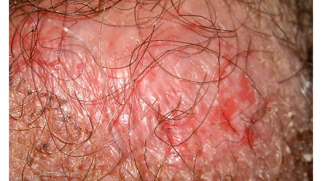 Blisters on penis from masturbation rough sex friction
