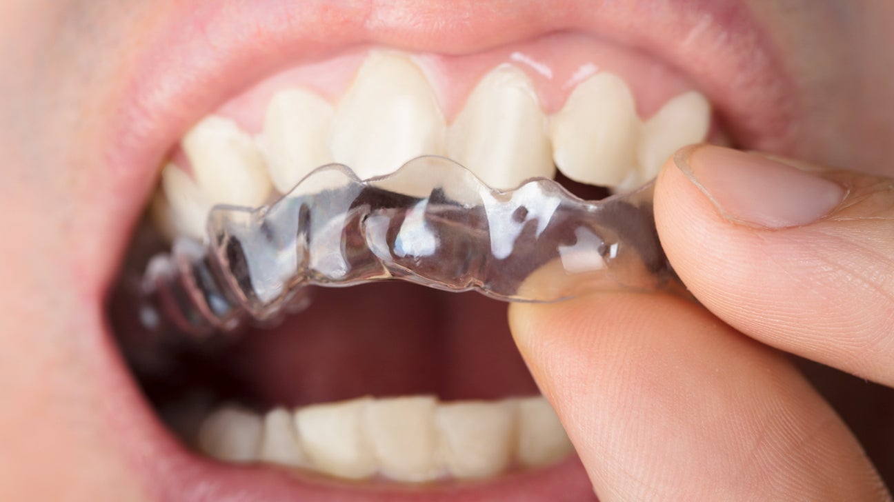 Orthodontic Appliances to Help Straighten Your Misaligned Teeth