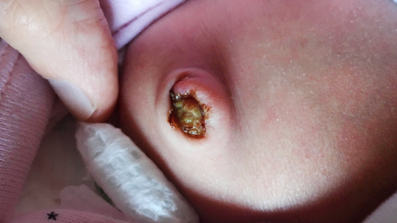 what does an infected umbilical cord stump look like