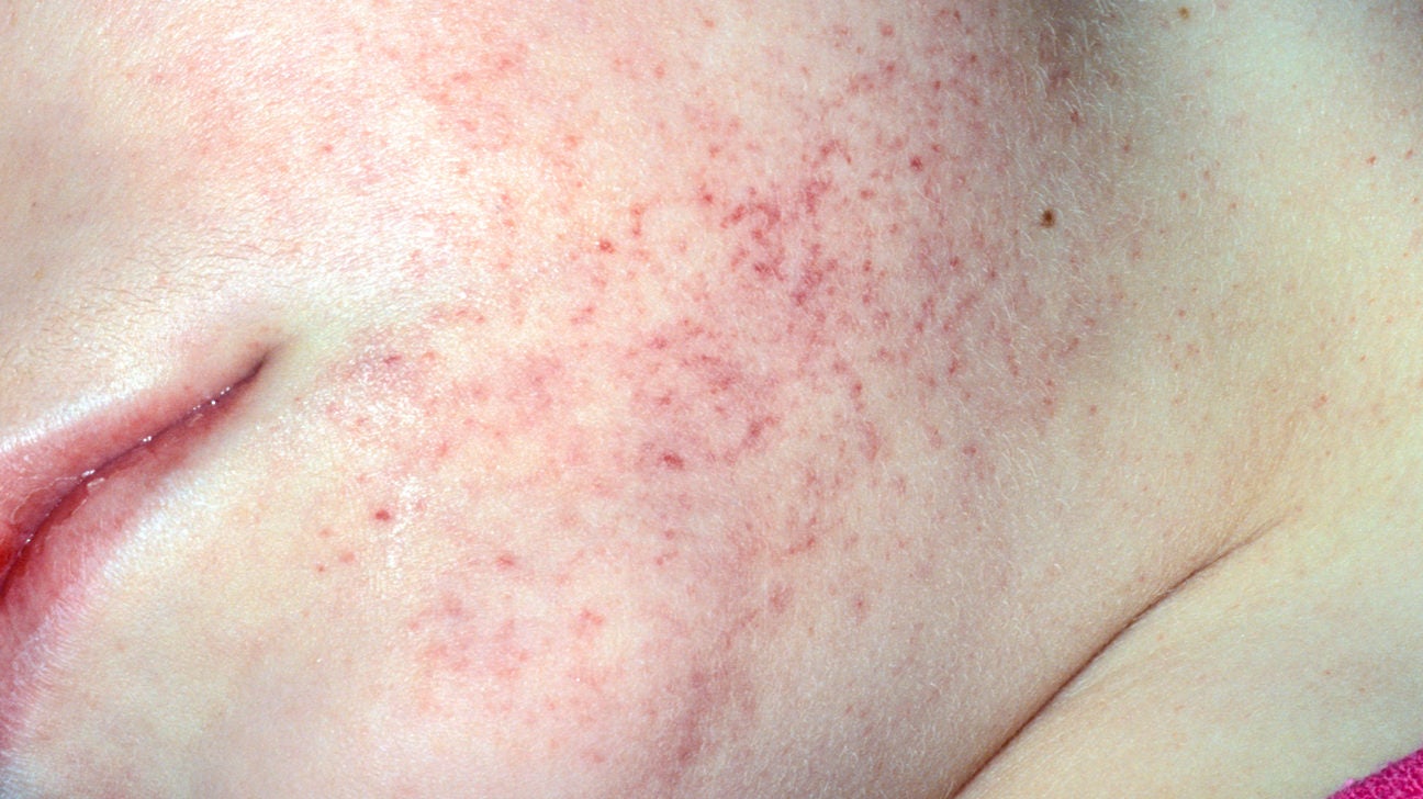 symptoms of petechiae