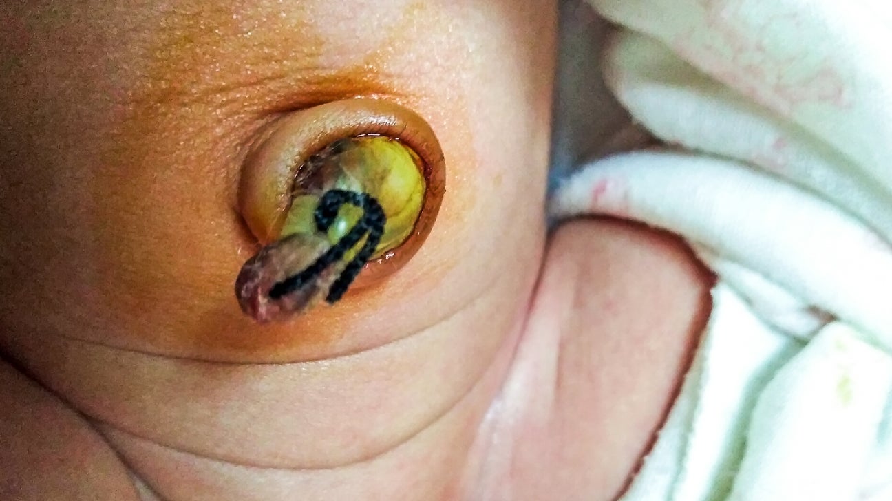 Newborn Umbilical Cord Care and Signs of Infection