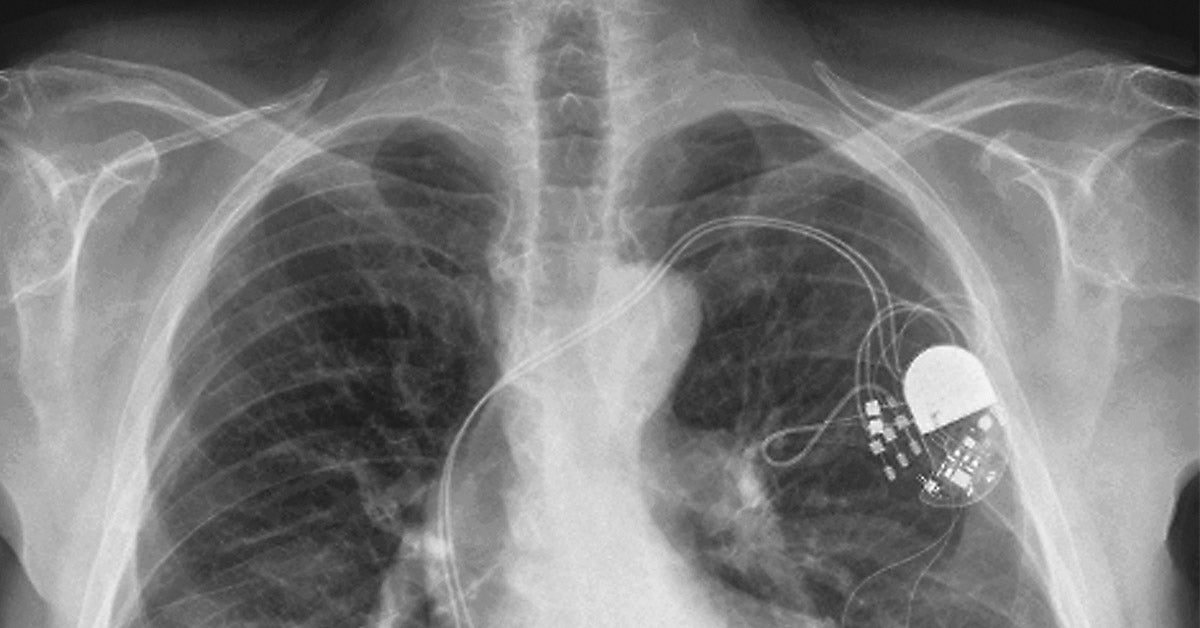 Medtronic Pacemaker X Ray Identification