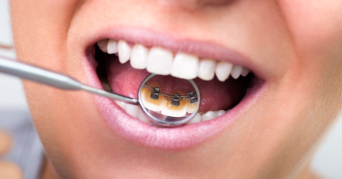 Lingual Braces Pros And Cons Cost Comfort Lisping And More