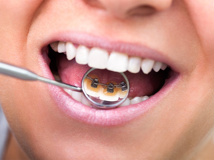 13 Main Things You Need To Know About Getting Braces in Singapore