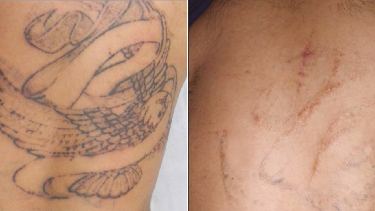 Lasering off tattoos before and after