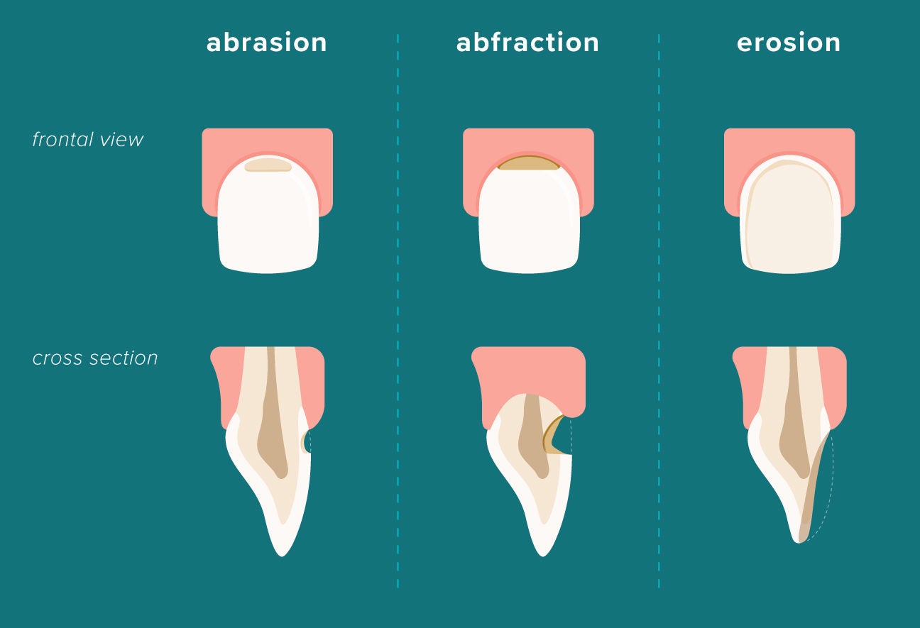 Tooth Erosion Treatment