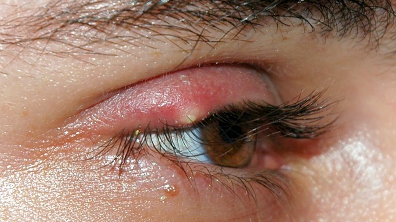 Stye Causes Symptoms Treatment Preventive Measures