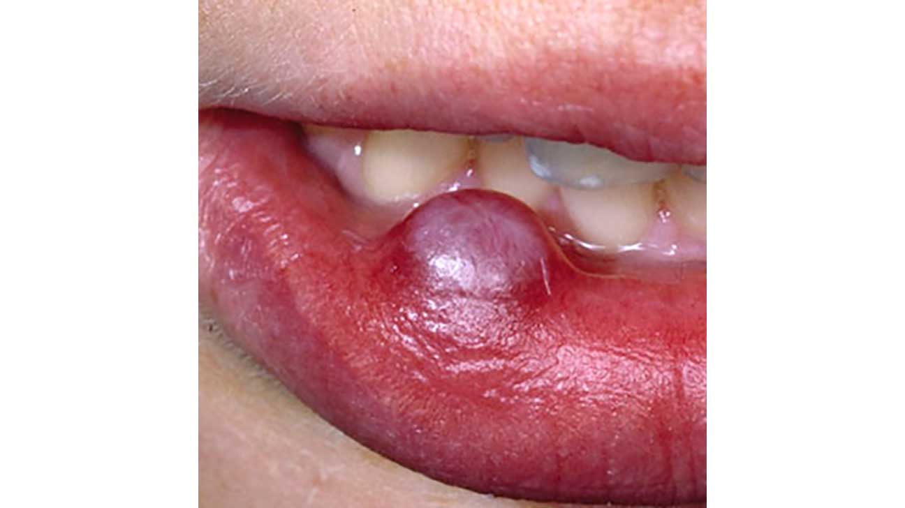 How To Remove A Cyst Medical Procedures Aftercare And More