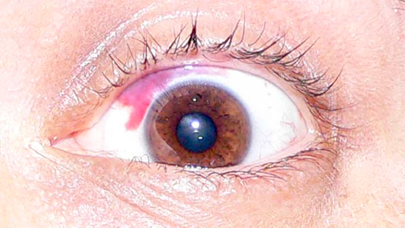 Can you wear contacts with broken blood vessel in eye Red Spot On Your Eye When To See A Doctor Causes Treatment More