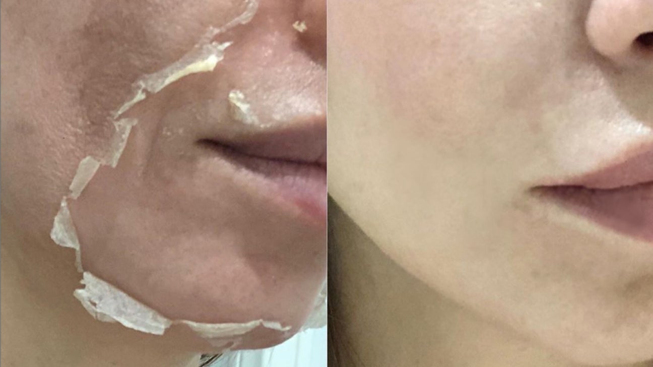 TCA Face Peel