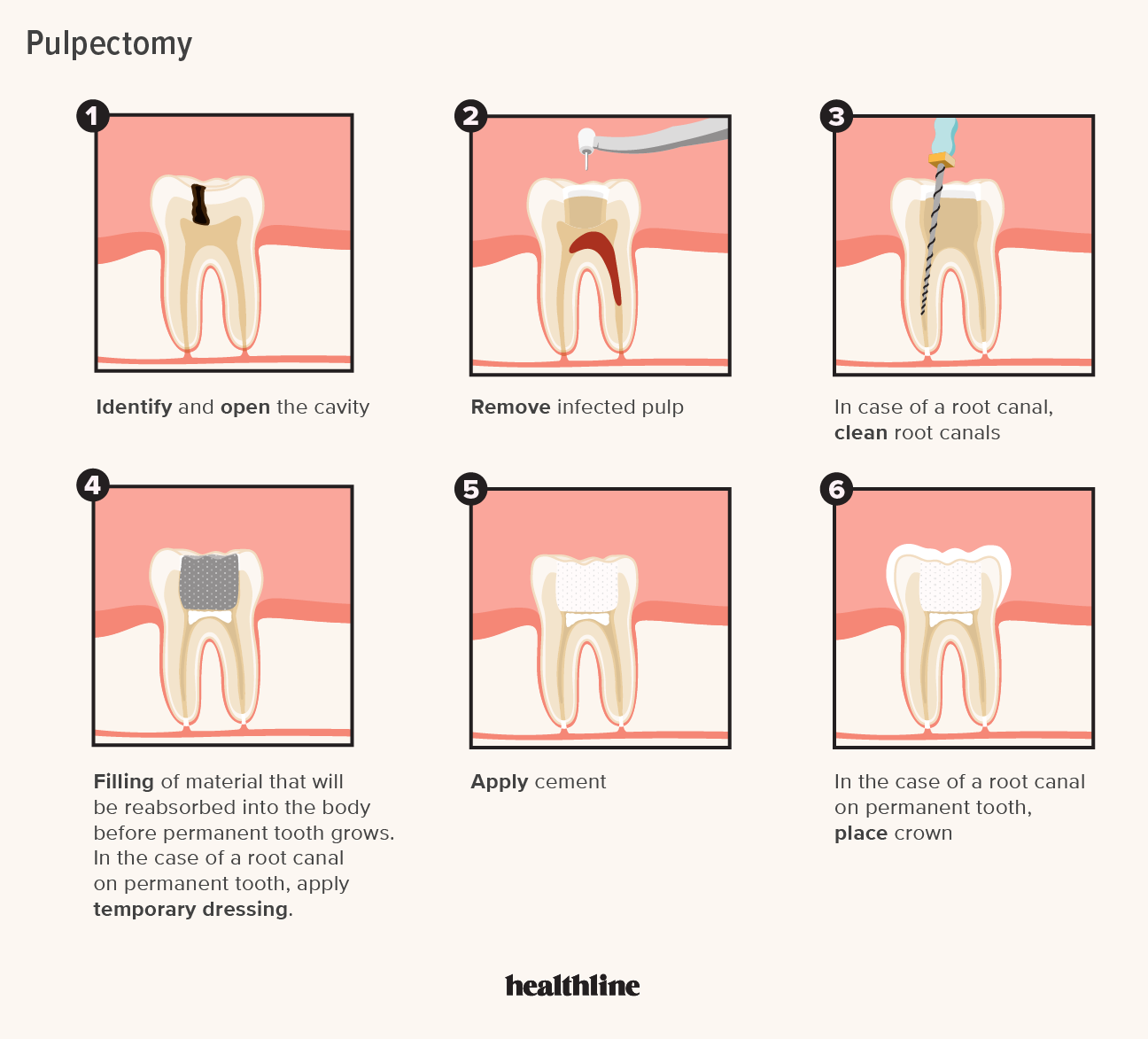 Pulpectomy Procedure, Cost, Recovery, and Comparison to Root Canal