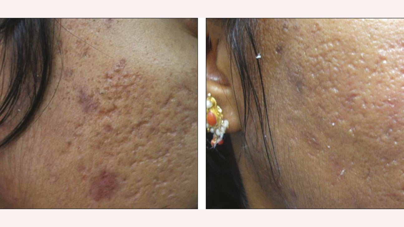 Let at forstå Håbefuld Tag et bad Laser Treatment for Acne Scars: What to Expect, Cost, and More