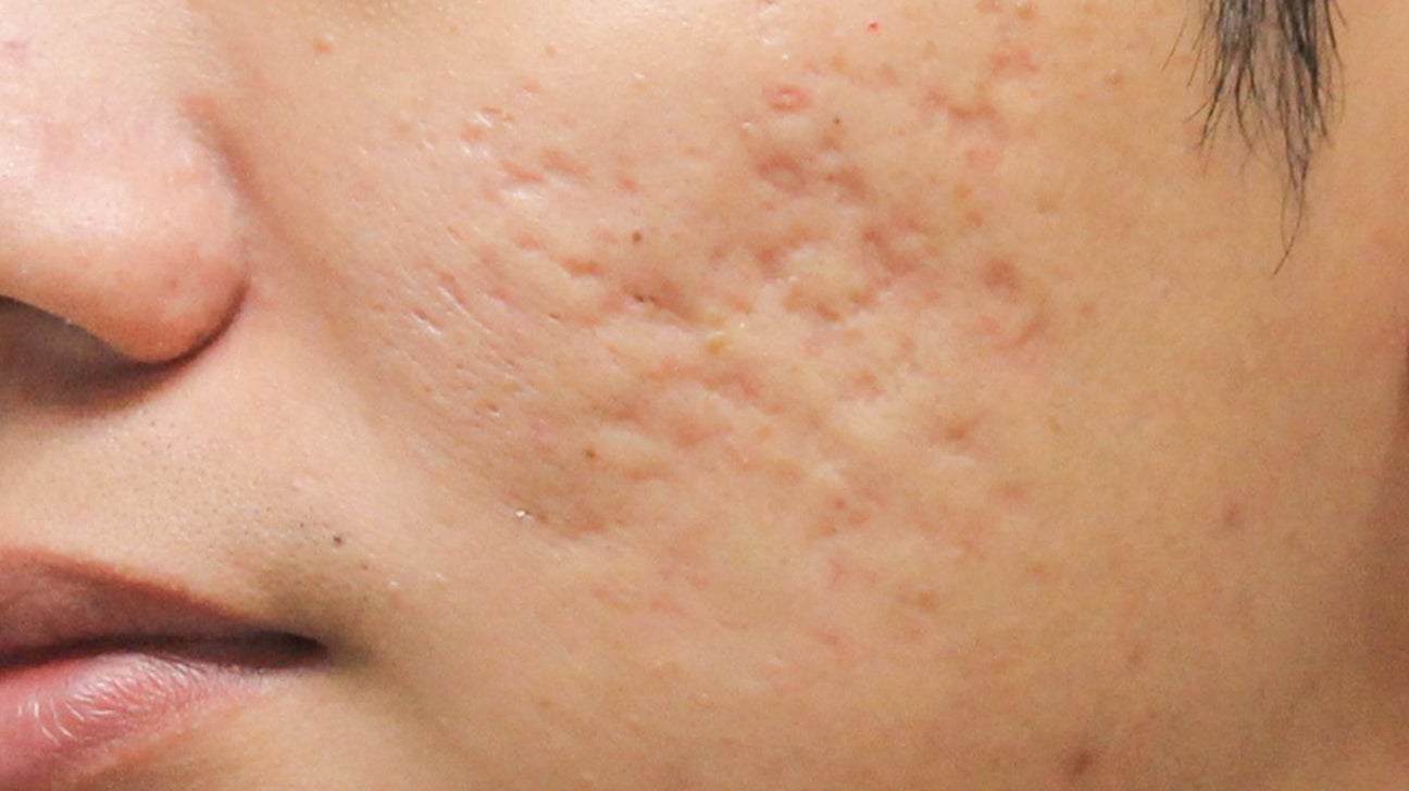 white acne scars on face