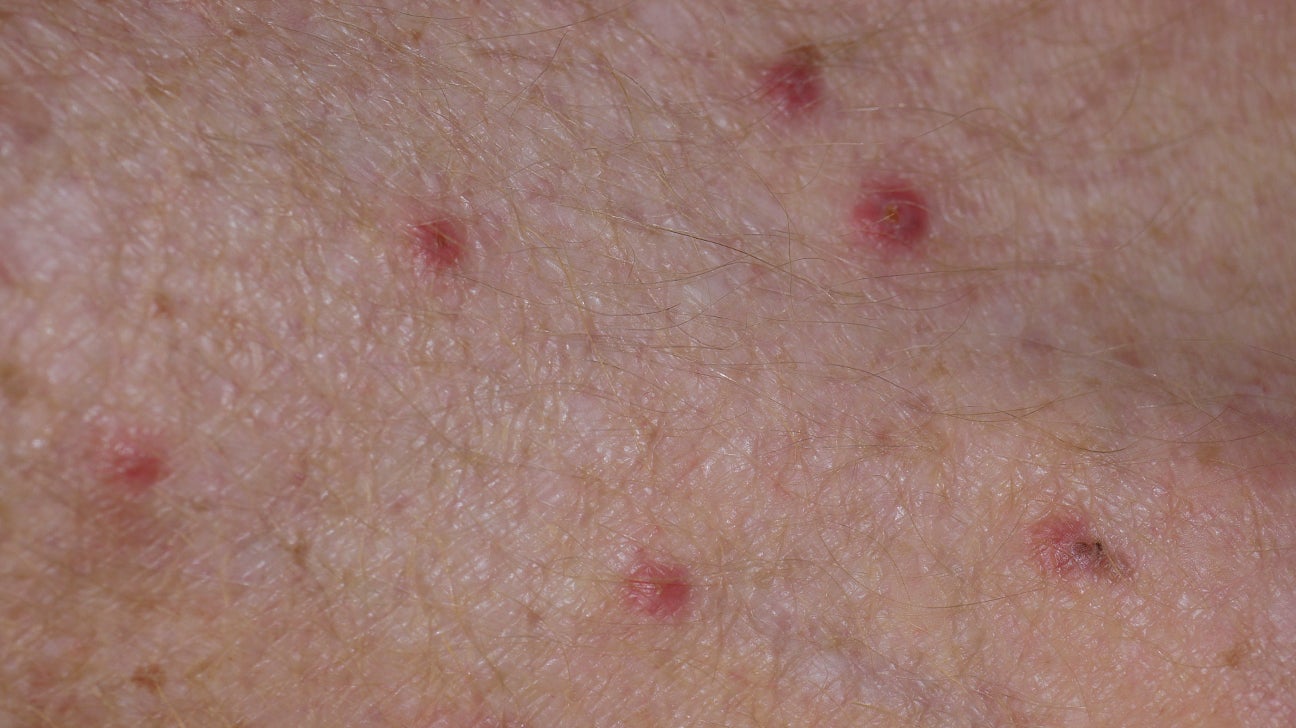 meth mites skin conditions