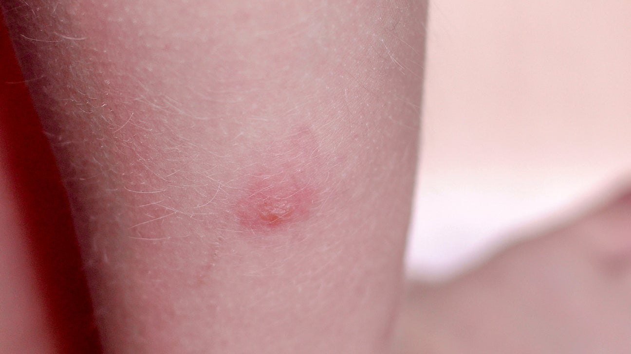 Scabies Bug Rash