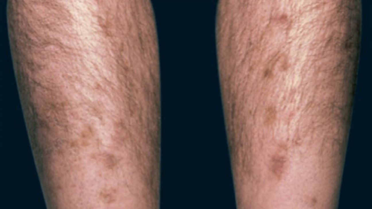 diabetic dermopathy legs pictures