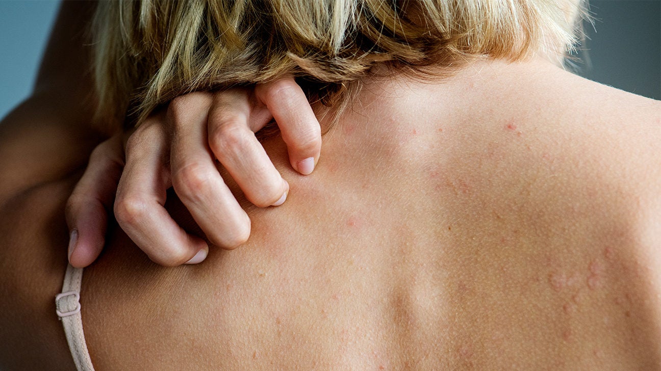 Want to get rid of rashes under your breast? Try these 8 effective natural  solutions
