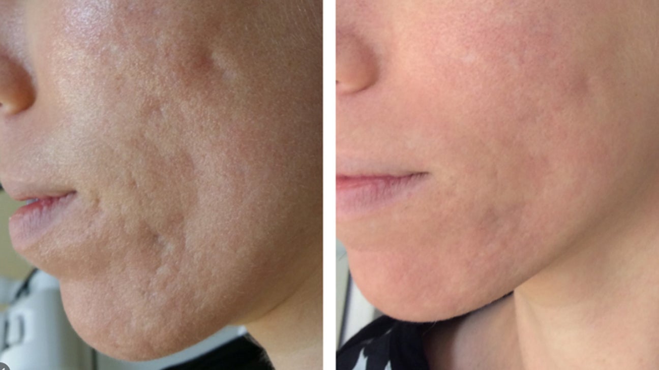 acne scars before and after laser