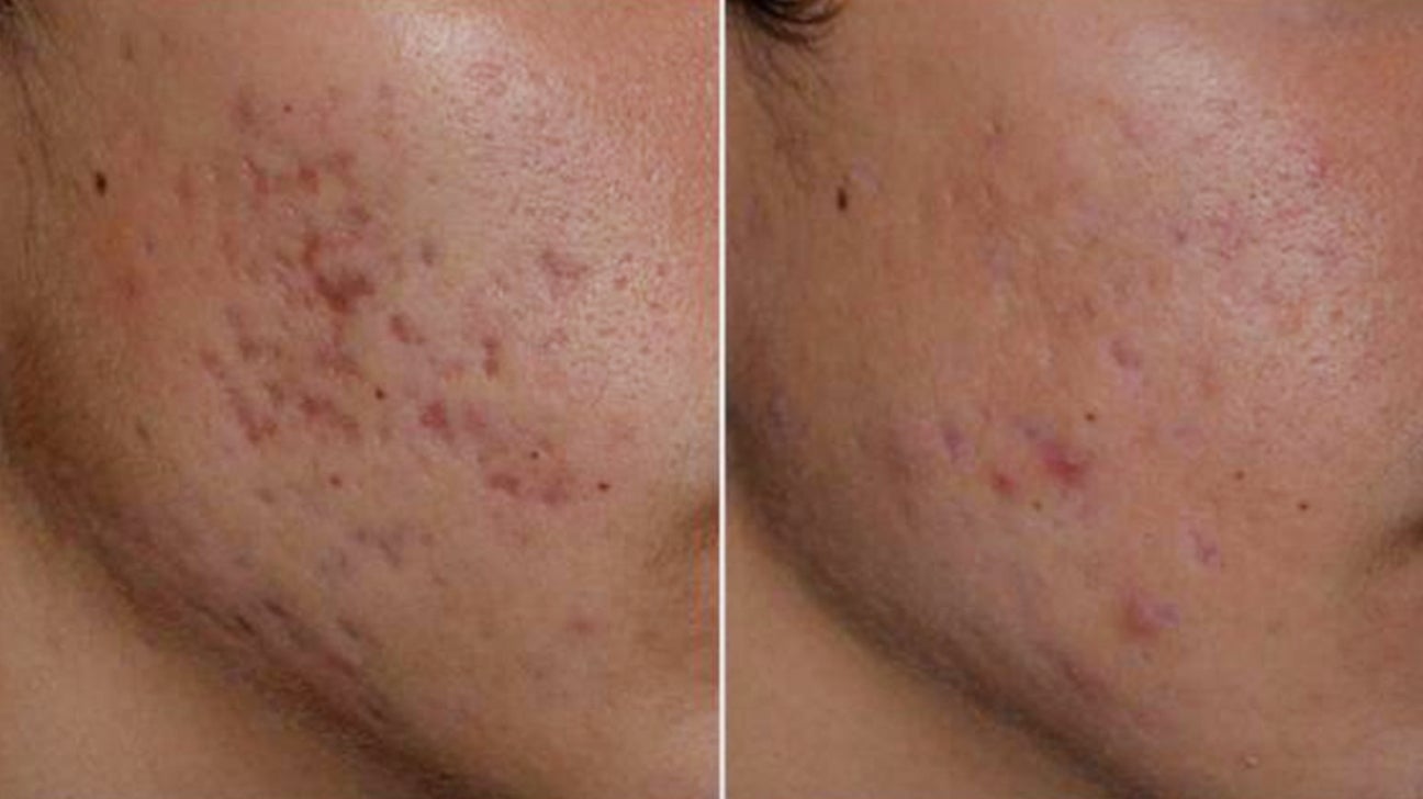 uddøde Meningsfuld Supersonic hastighed Laser Treatment for Acne Scars: What to Expect, Cost, and More