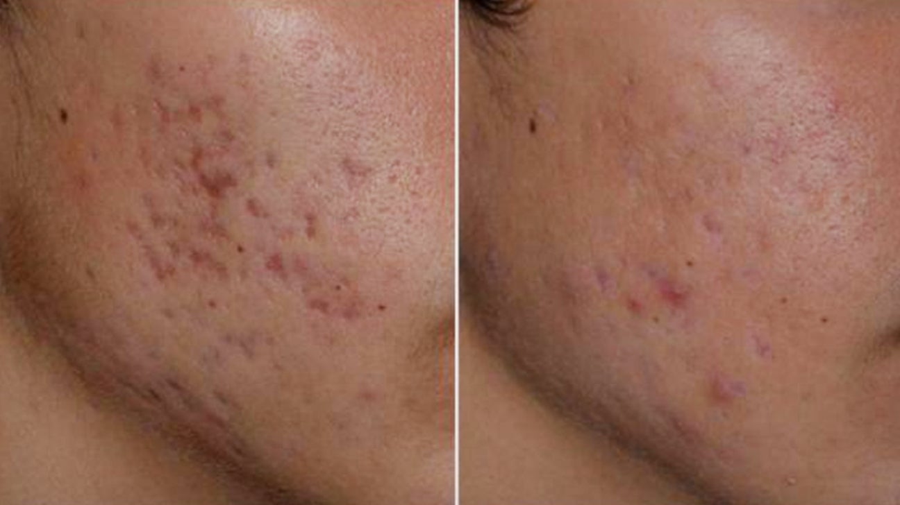 acne scars