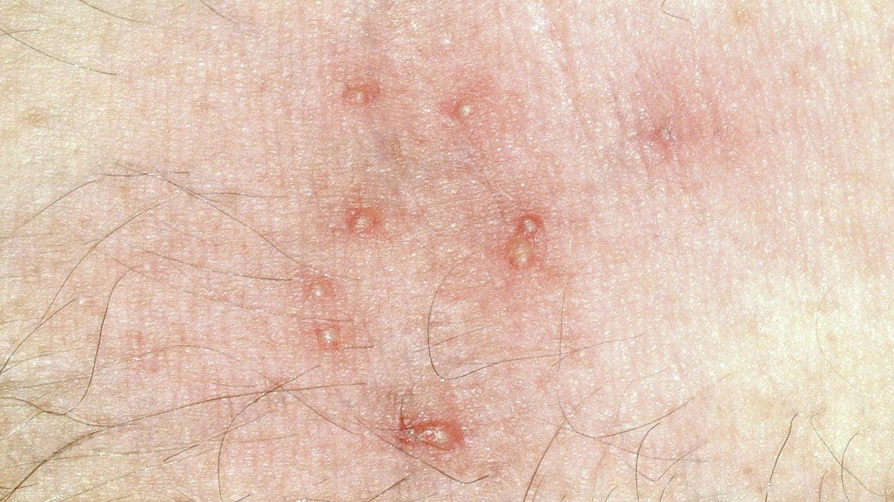 bed bug bites on genital area