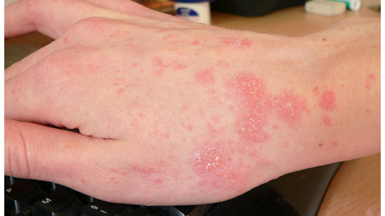 Scabies Mite Bites