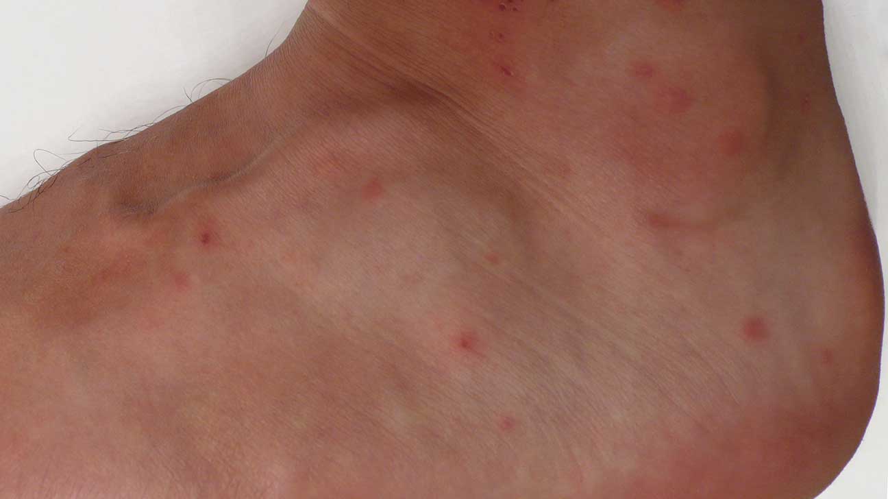 chigger bites vs bed bug bites