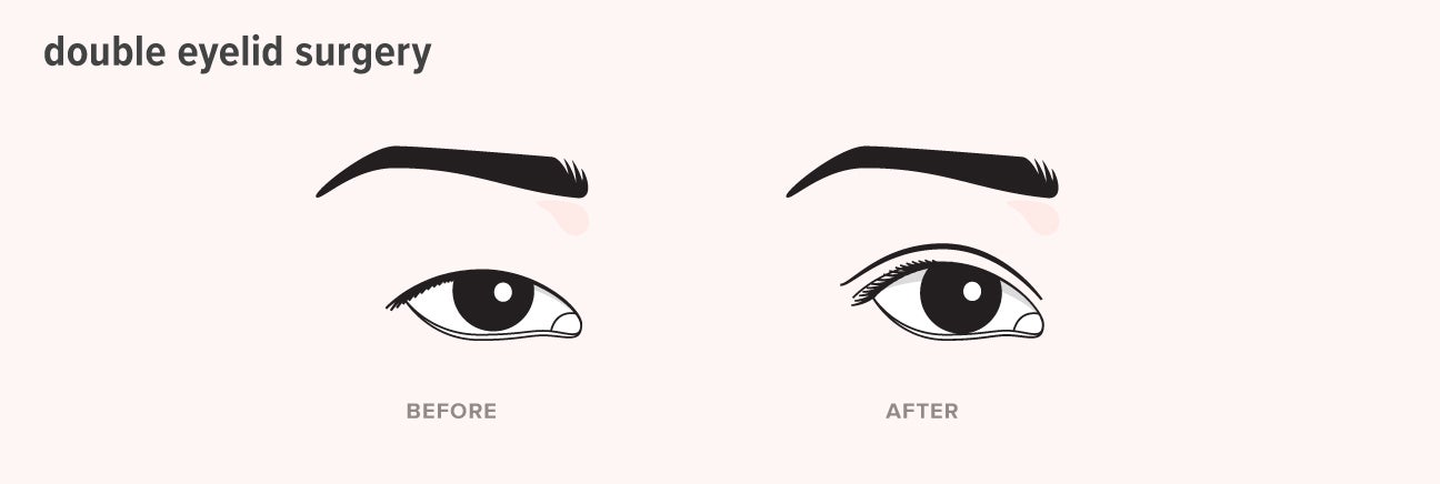 how to make double eyelid permanent