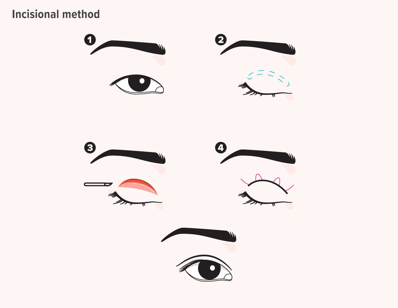 double eyelid training