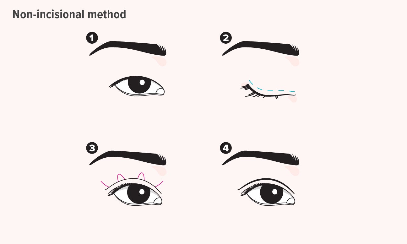 Double Eyelid Surgical Nonsurgical Options Pictures Cost More