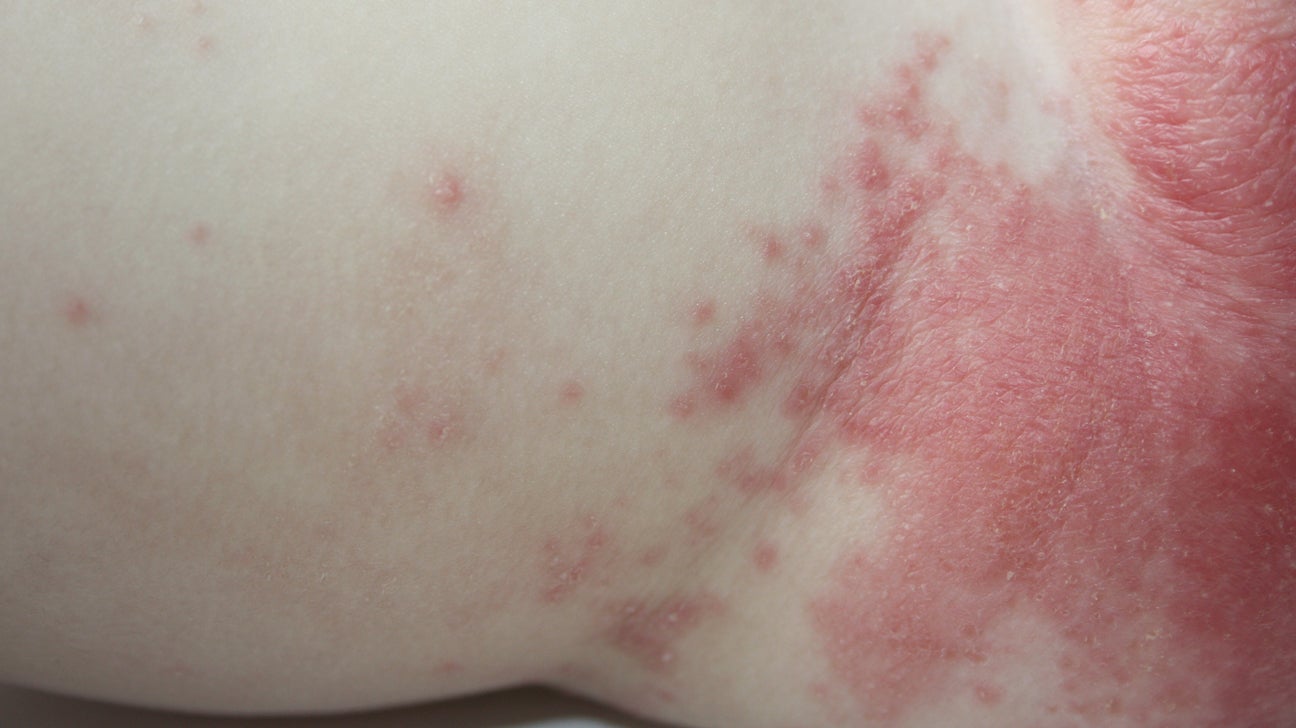 staph infection diaper rash