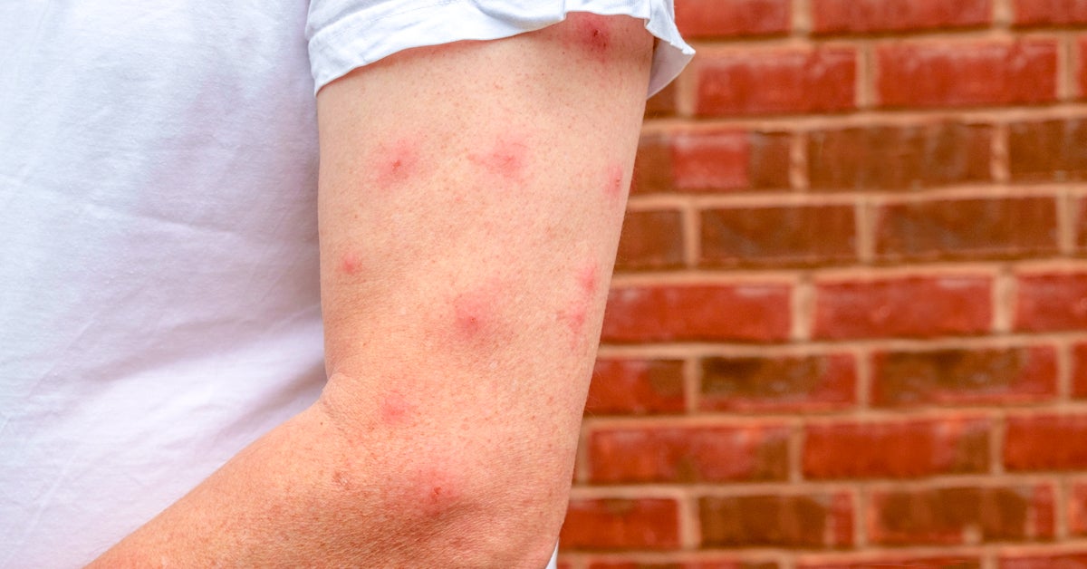 Mosquito Bites: What They Look Like, Why They Itch Treatment | atelier ...