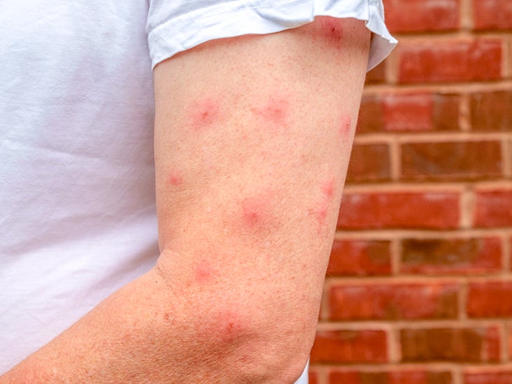 Mosquito Bite Blisters What Causes Them And How To Treat Them