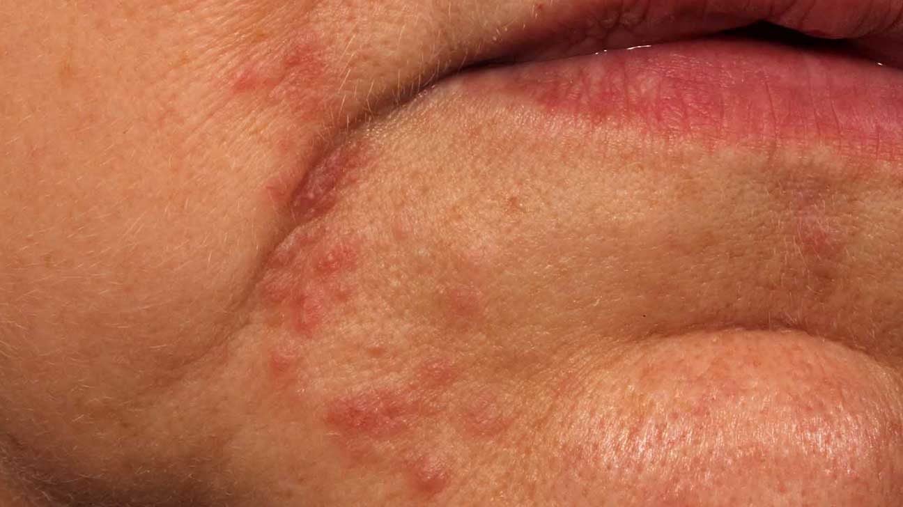 Flaky Skin On Face Around Mouth / Red Rash Around Your Mouth Could Be Perio...