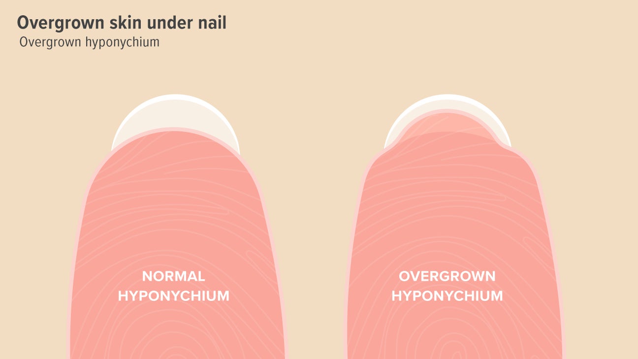 Hyponychium (Under-Fingernail Skin) Thickening Causes and Treatment